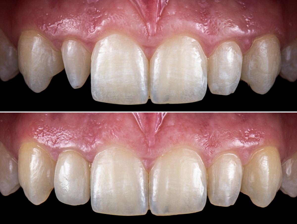 Clinical example — composite bonding and whitening