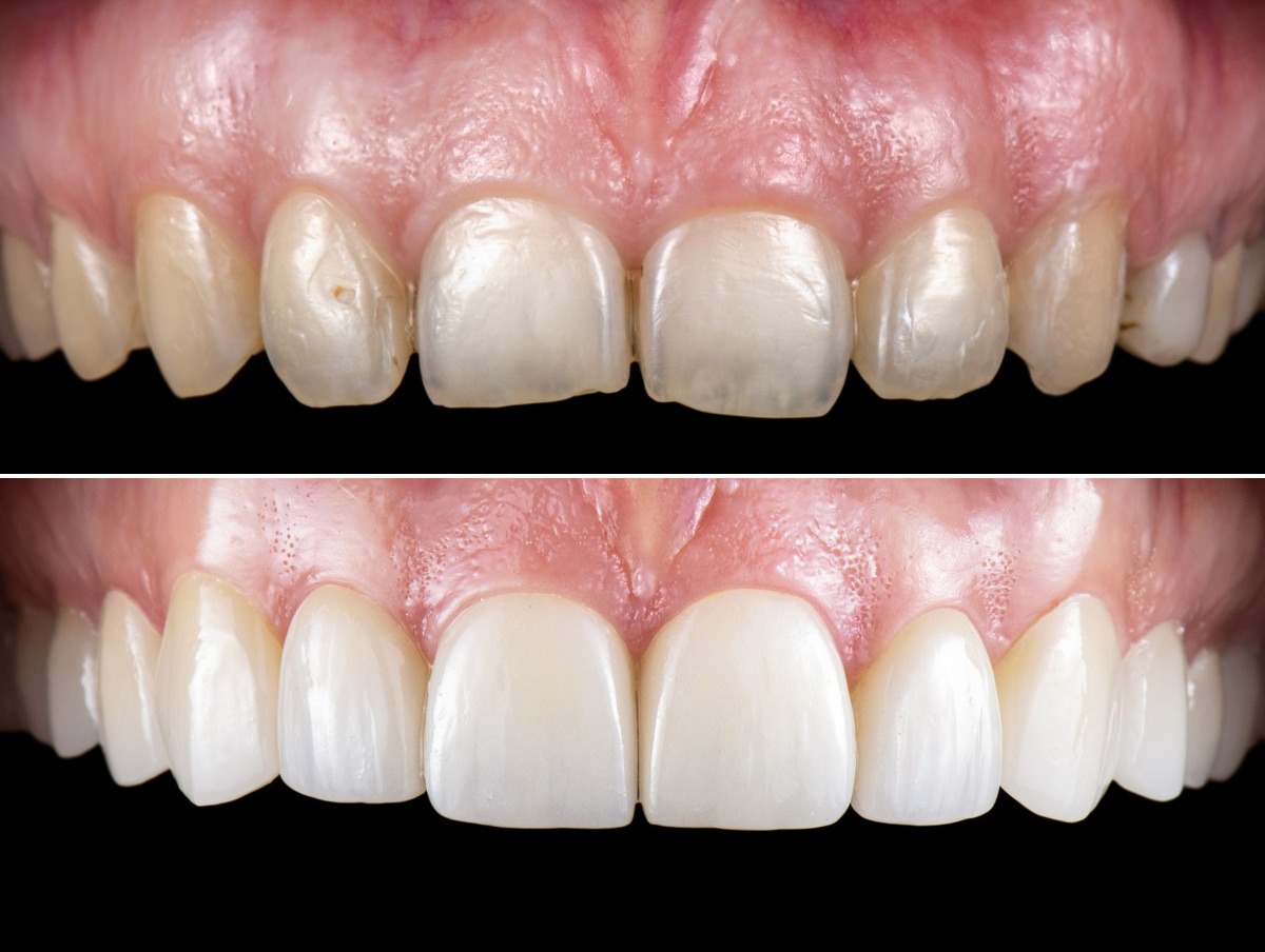Clinical example — aesthetic composite transformation