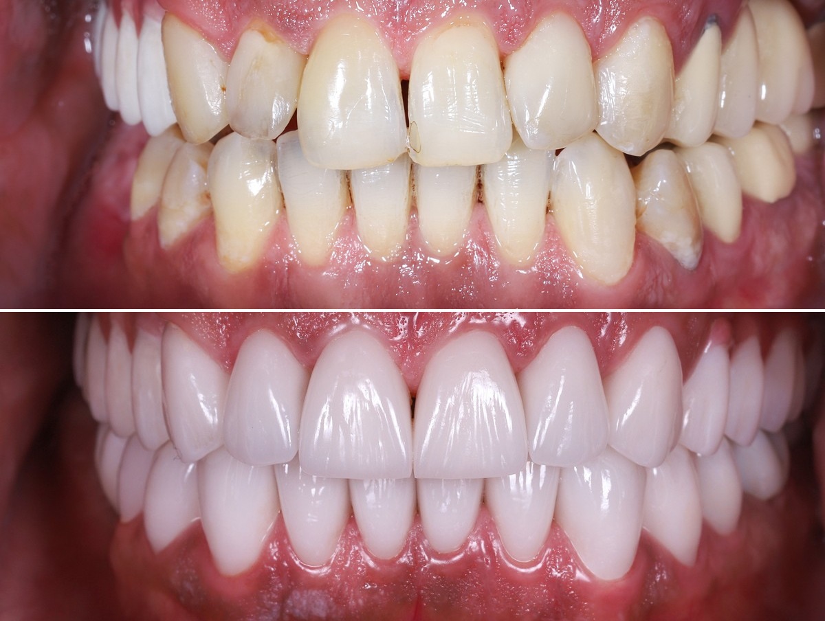 Clinical example — veneers and crowns combination