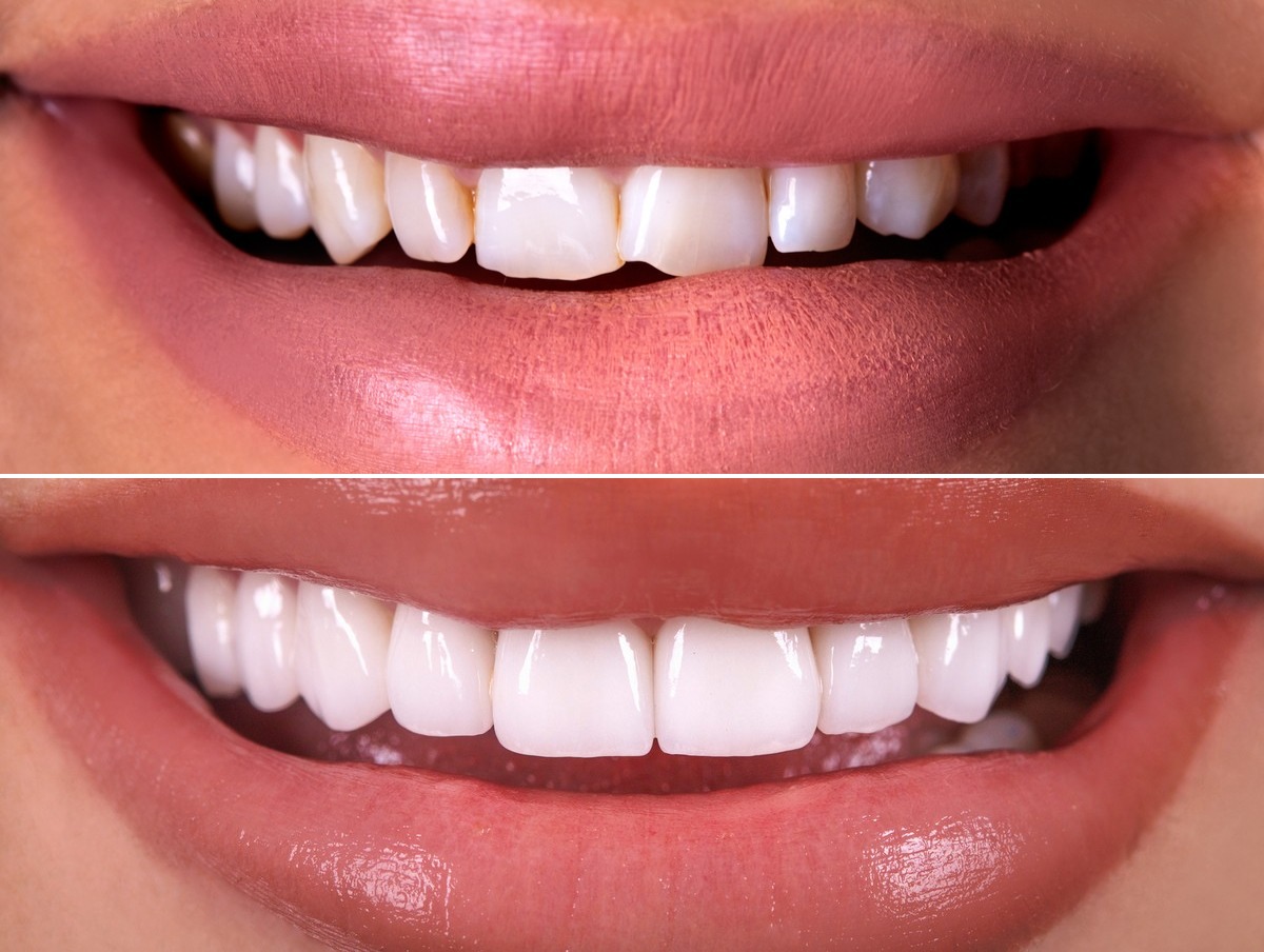 Clinical example — full mouth smile transformation
