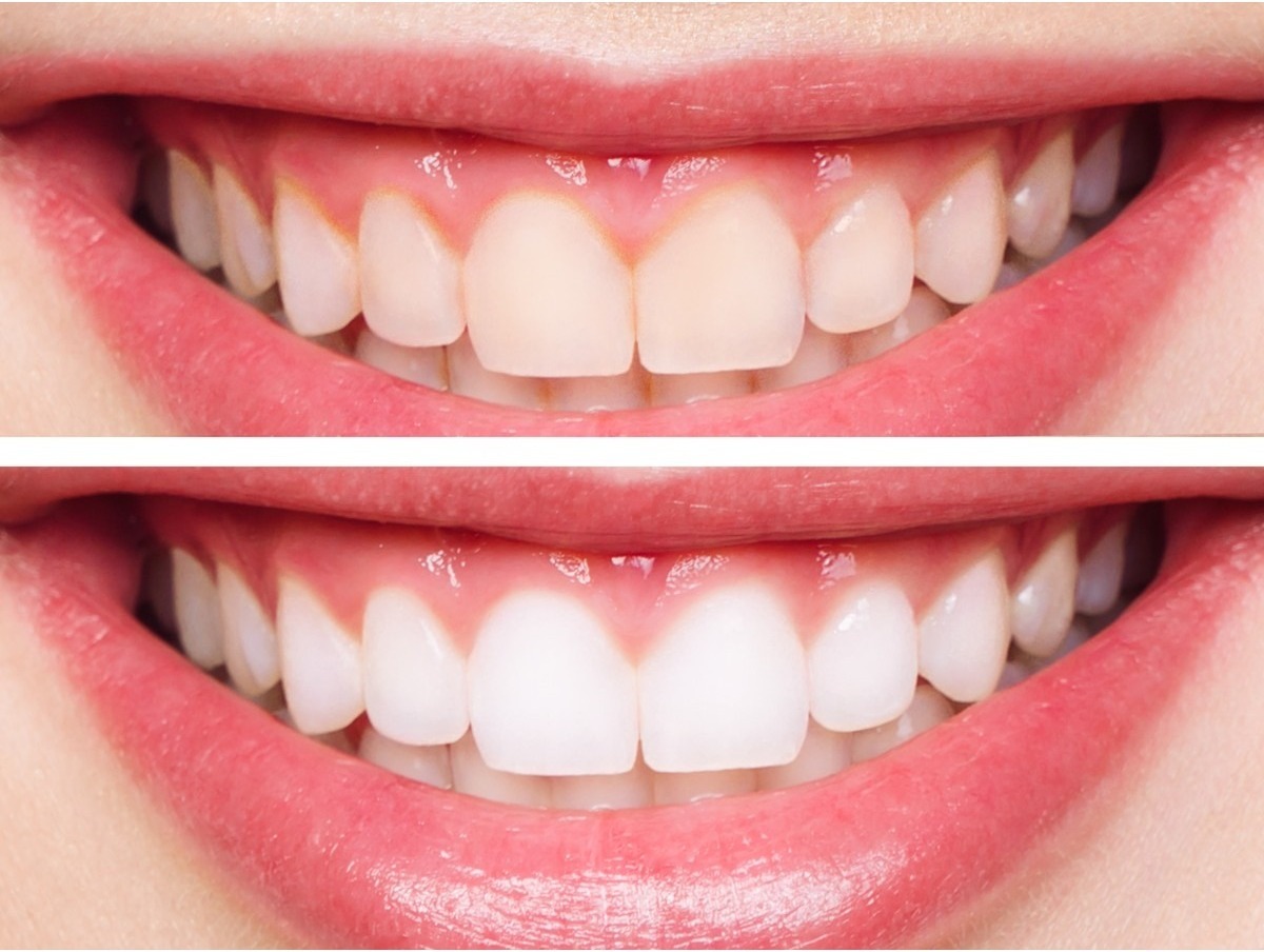 Clinical example — professional teeth whitening