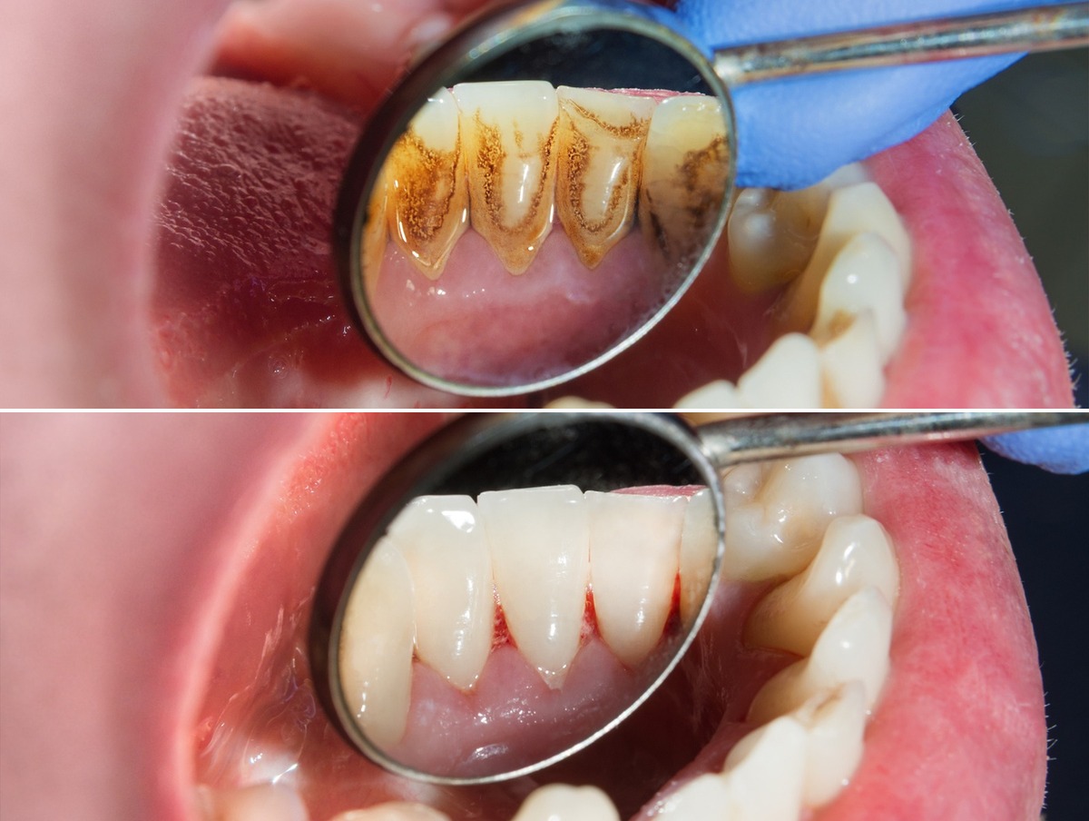 Clinical example — deep clean and hygiene