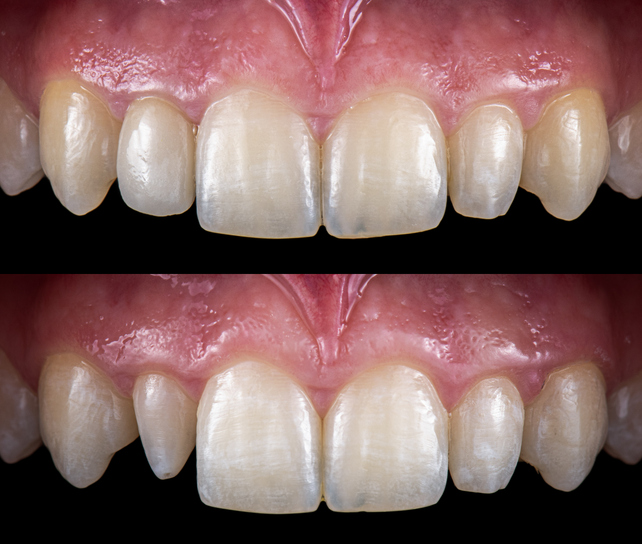 Before and after composite bonding — upper front teeth reshaped and brightened in a single visit