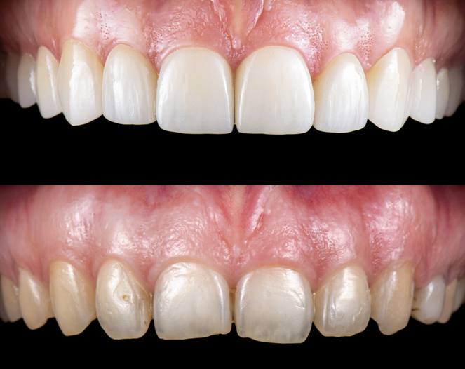 Before and after cosmetic dentistry — chipped, worn upper front teeth restored to a bright, even smile