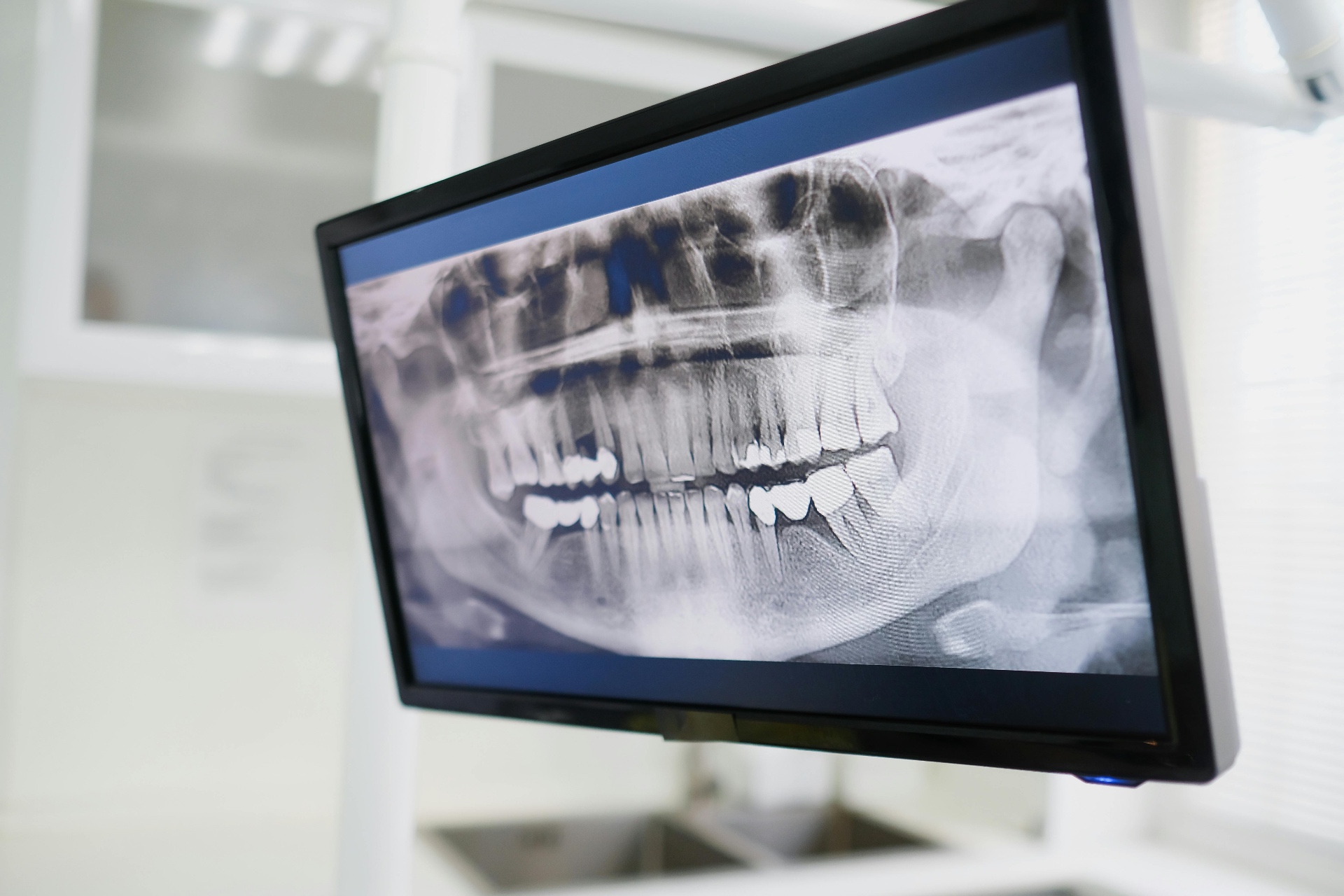 Panoramic dental X-ray displayed on a surgery monitor to plan a crown or bridge