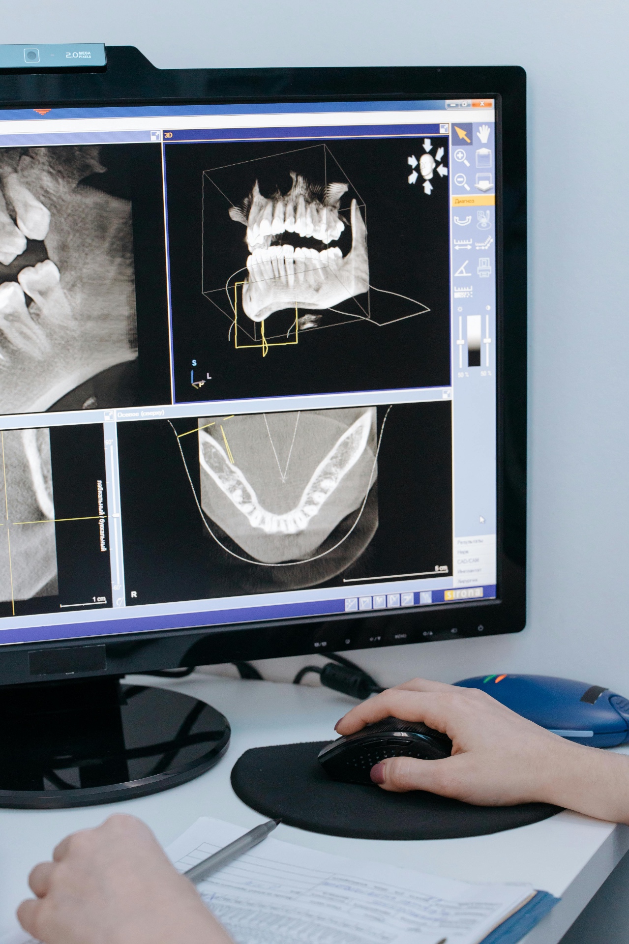 3D CBCT scan used to plan precise dental implant placement