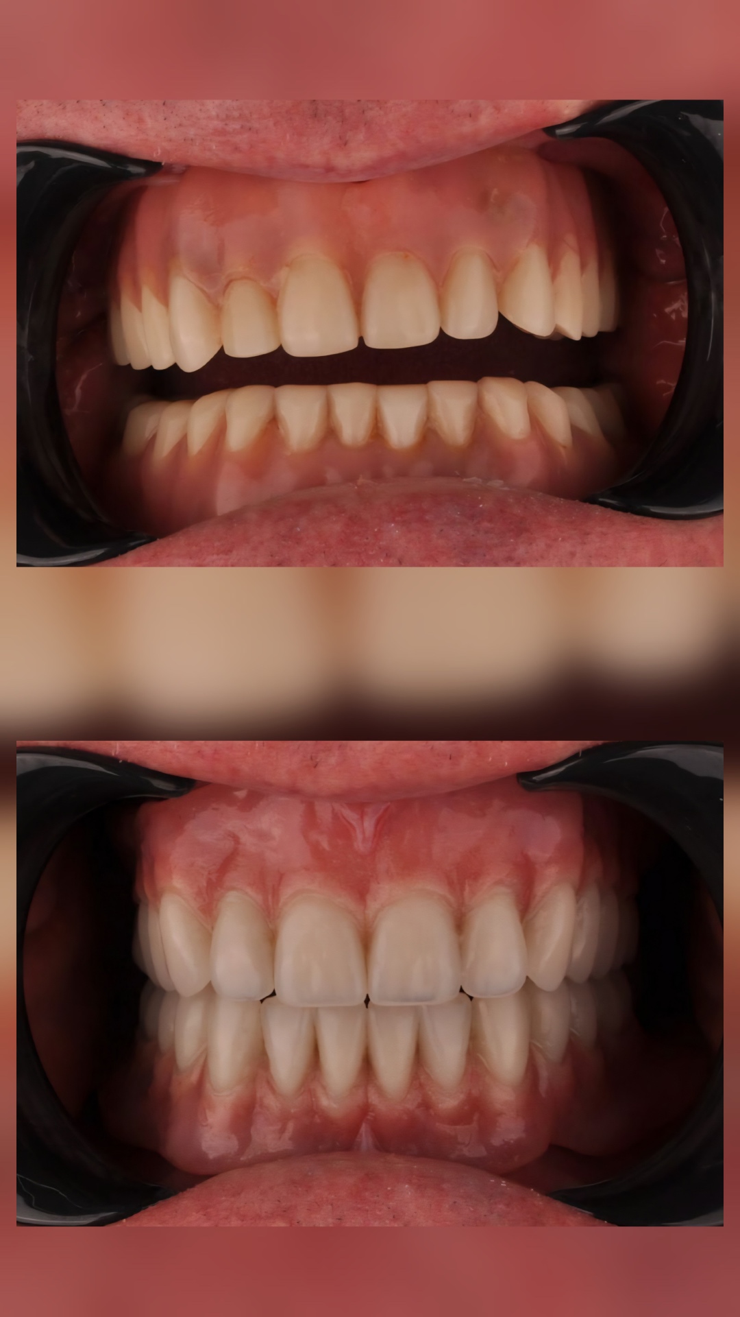 Before and after clinical photographs showing a patient's smile restored with bespoke dentures — improved tooth alignment, shade and gum aesthetics