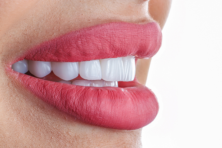 Porcelain Veneers