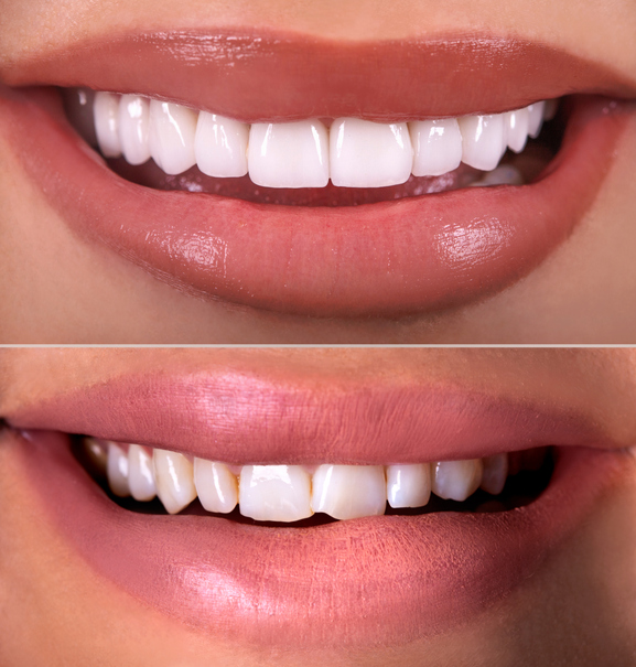 Before and after porcelain veneers — uneven, slightly discoloured upper teeth restored to a bright, even smile